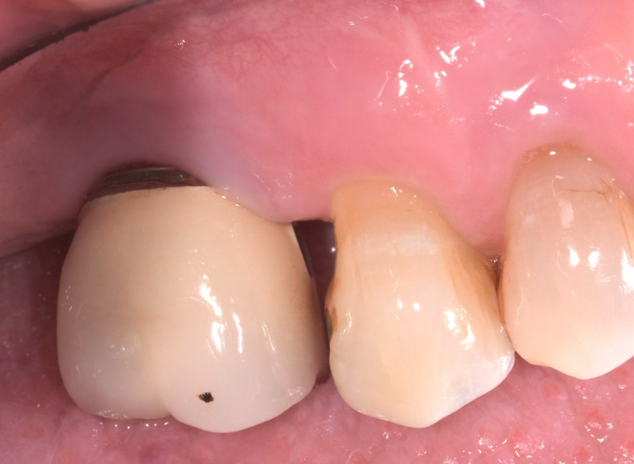 Periimplantitis after treatment
